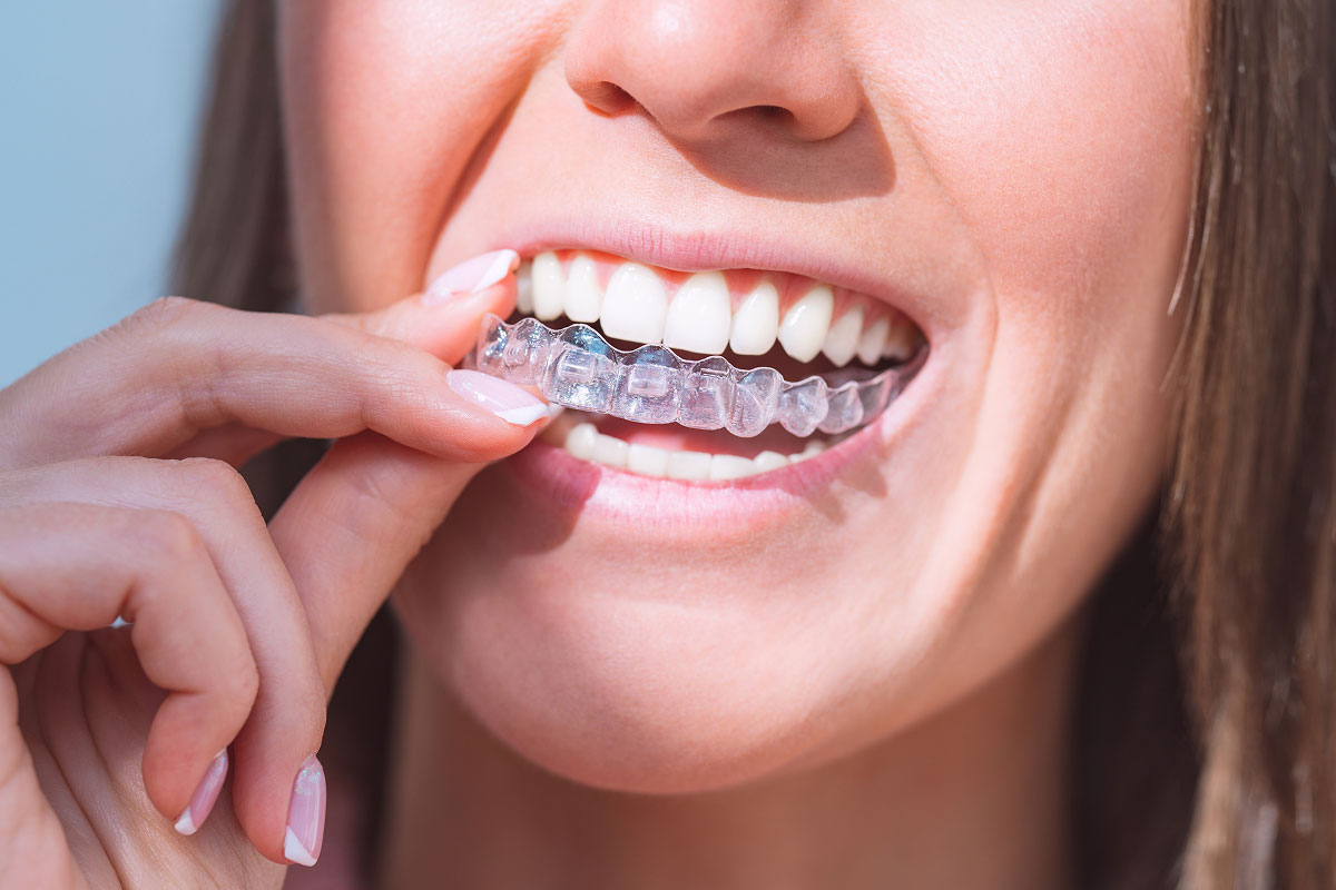 clear aligners offered at Pendleton Smiles