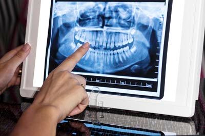 digital X-rays used at Pendleton Smiles