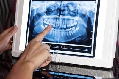 digital X-rays used at Pendleton Smiles